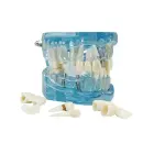 Dental jaw model with implants — Photo 10