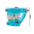 Dental jaw model with implants — Photo 7