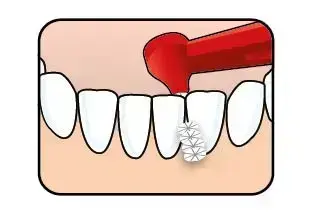 TePe Interstitial Brushes - 6 Pcs Foto 2