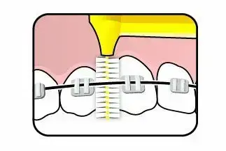 TePe Interstitial Brushes - 6 Pcs Foto 3